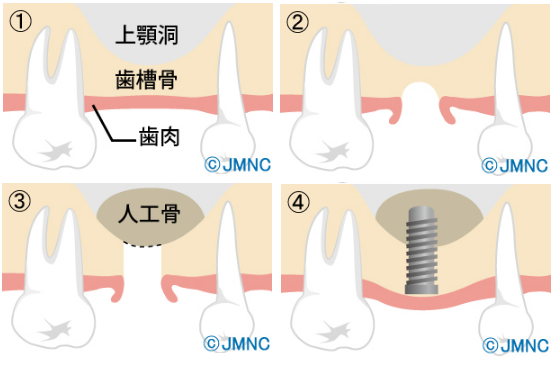 ソケットリフトの治療方法～骨の高さが5mm以上ある場合～