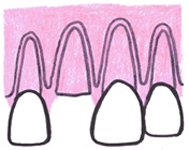 抜歯後に骨を再生させる方法とそれにかかる期間