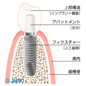 上部構造は何で作られているの？