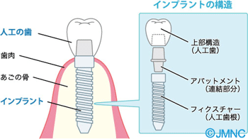 インプラントの構造