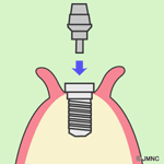 アバットメント接続