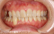 軽度の歯周病(歯肉炎)