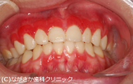 中程度の歯周病（歯周炎）