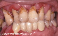 重度の歯周病(歯槽膿漏)