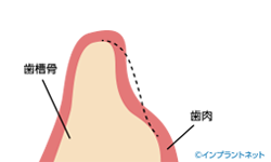 骨組織が欠損している状態