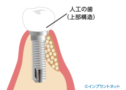 インプラント　人工歯