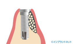 インプラント　人工歯