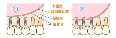 補助手術ってなんですか？