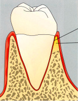 再生された歯根膜