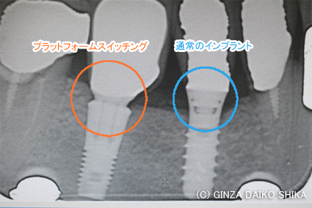  骨吸収しにくいインプラントの構造-プラットフォームスイッチング