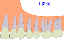 サイナスリフト１