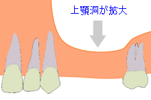 サイナスリフト2