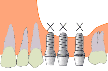 サイナスリフト3