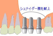 サイナスリフト4