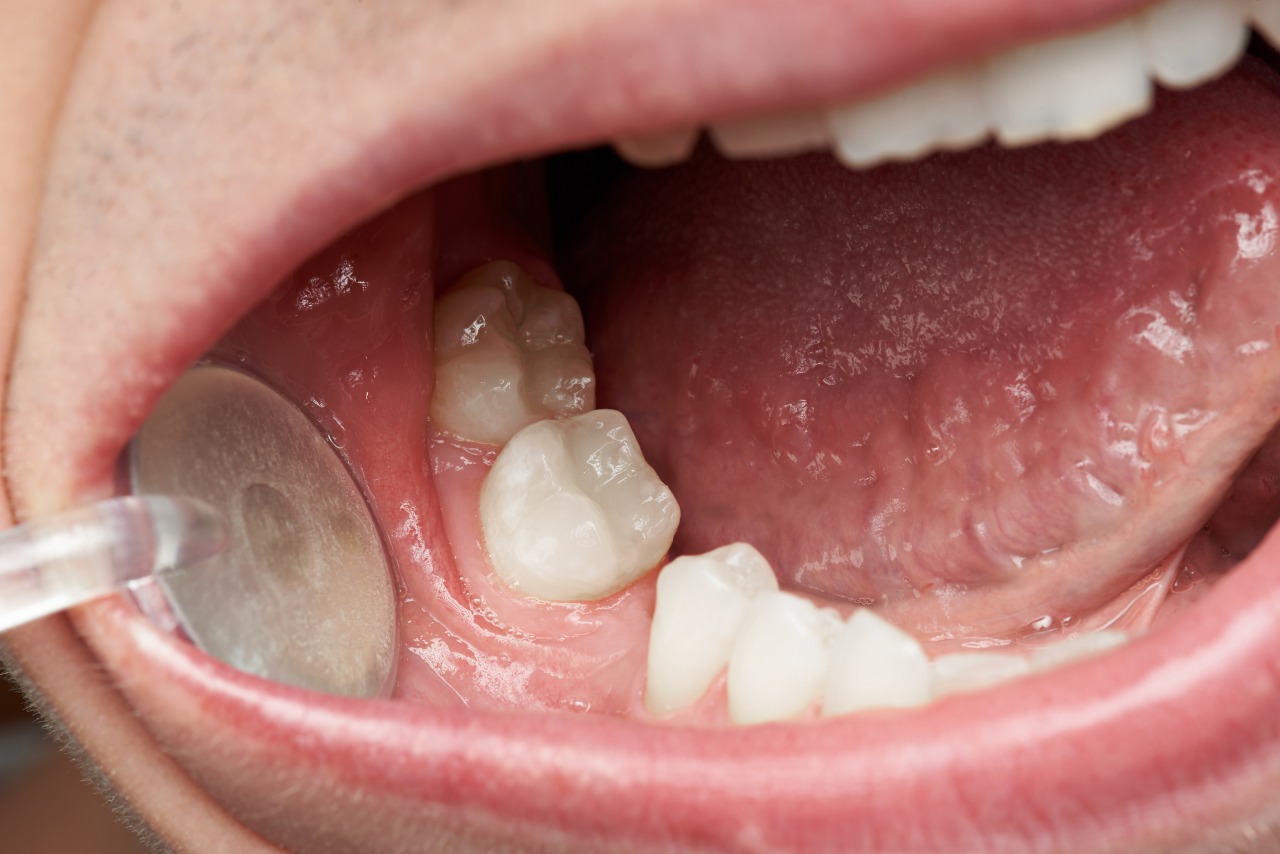 先天性欠如歯の治療方法は インプラント 歯列矯正など インプラントネット