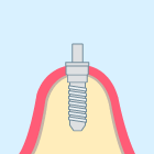 1. インプラントの埋入手術③