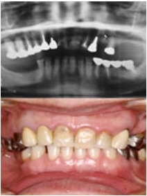 臼歯部の咬合支持をインプラントによって改善治療前