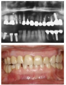 臼歯部の咬合支持をインプラントによって改善治療後