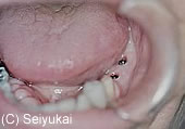 1.フィクスチャー埋入