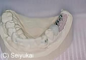 2.支台(アバットメント)作製