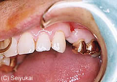 歯を1本失った場合のインプラント症例治療前