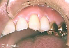 歯を1本失った場合のインプラント症例治療後