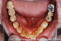 Case　重症の歯周病者の咬合機能を回復したい