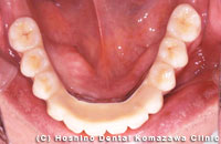 STEP3 インプラント固定式義歯の装着