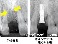 インプラントの埋入