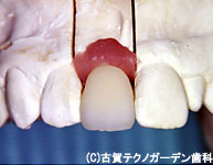STEP3　人工の歯を作成