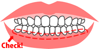 治療後の歯茎のライン