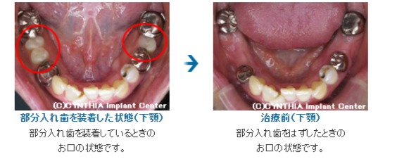 治療前のお口の状態