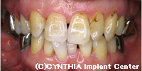 人工の歯を装着した後のお口の状態1治療前
