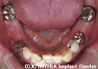 人工の歯を装着した後のお口の状態2治療前