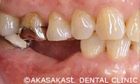 歯を失った部分の歯茎