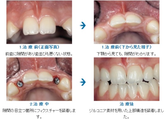ジルコニアをもちいて審美的にインプラント治療をおこなったケース