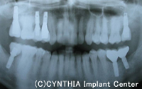 AFTER　治療後のレントゲン