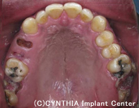 CASE　長年放置していた虫歯を抜歯して、インプラントで治療治療前