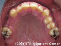 CASE　長年放置していた虫歯を抜歯して、インプラントで治療治療後