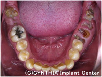 CASE　長年放置していた虫歯を抜歯して、インプラントで治療治療前