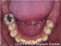 CASE　長年放置していた虫歯を抜歯して、インプラントで治療治療後