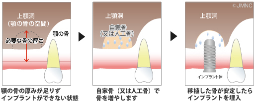  [参考] 上顎の骨の厚みが足りない人への骨移植の流れ