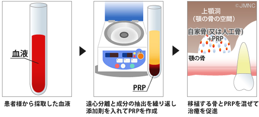 PRP再生療法を併用した骨移植について