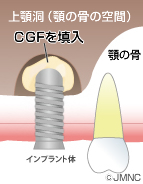  顎の骨が少ない方のCGF（再生療法）を併用したインプラント治療