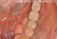 「インプラント治療+セラミック治療」を行った例治療後