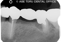 「インプラント治療+セラミック治療」を行ったレントゲン治療前
