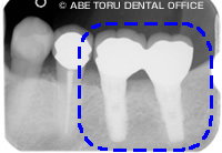 「インプラント治療+セラミック治療」を行ったレントゲン治療後