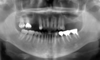 術前のパノラマX線像