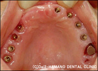 CASE1　上顎の歯がほとんど無い方治療前