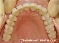 CASE1　上顎の歯がほとんど無い方治療後